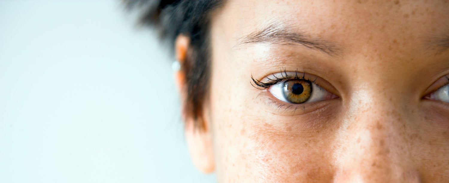 A woman's right eye showing signs of eye diseases
