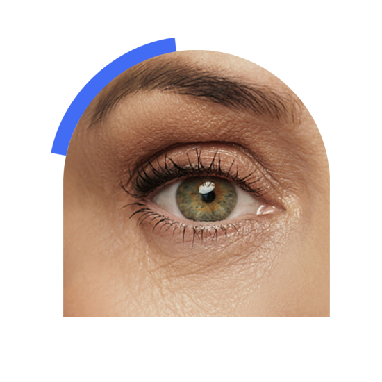 A bold eye infected with dry eye disease