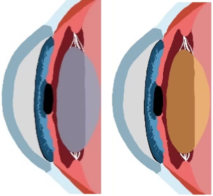 Cataract Surgery (Intra-Ocular) Lens Options